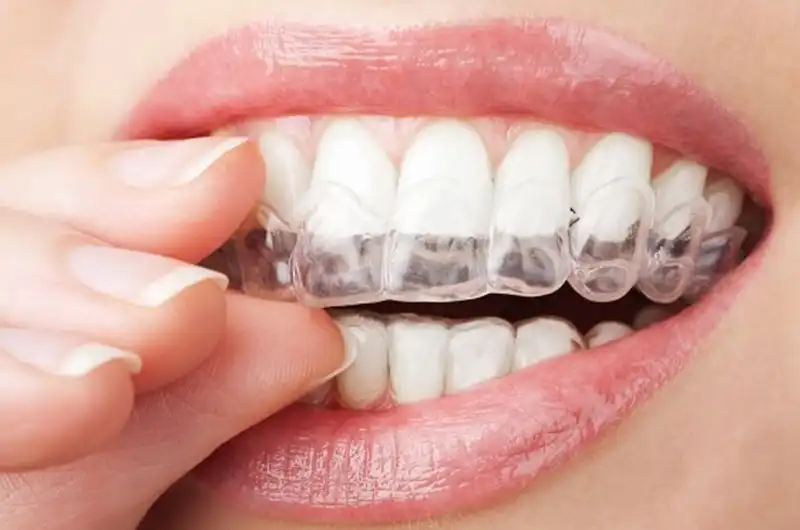 Invisalign