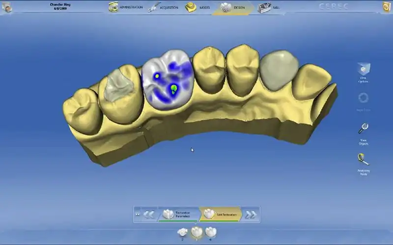 Cerec Kronen/ Inlay's & Veneer's